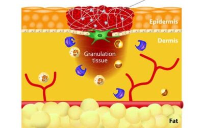 Inflammation